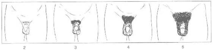 Figure 3. Stades pubertaires du développement du système pileux pubien et génital du garçon