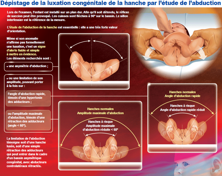 Haute Autorite De Sante Luxation Congenitale De La Hanche Reiterer Les Examens De Depistage Jusqu A L Age De La Marche