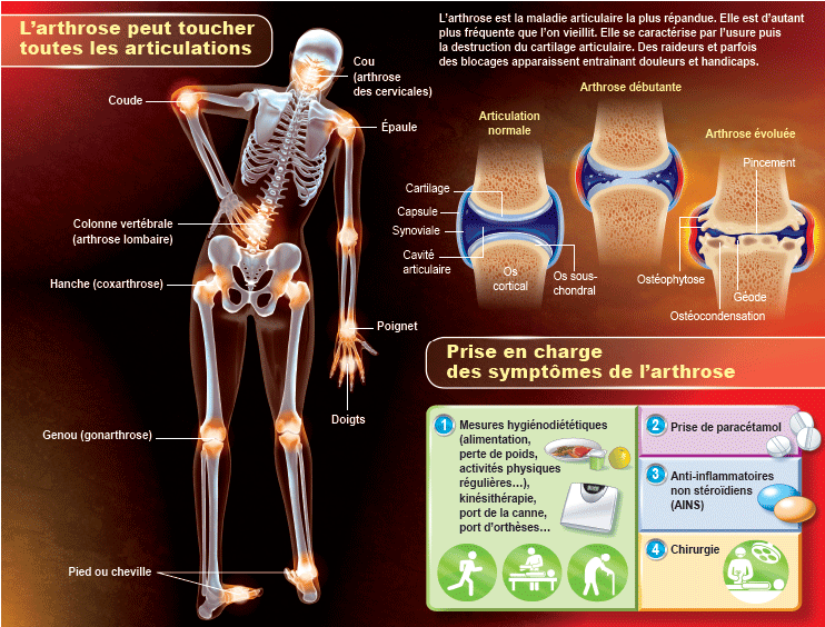 Arthrose : les articulations les plus touchées par l'arthrose - Arthrolink