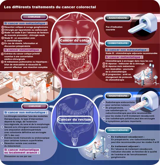 Les différents traitements du cancer colorectal - petit format