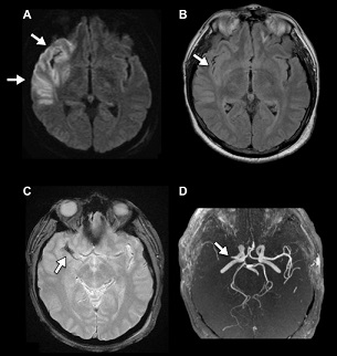 Haute Autorite De Sante Place De L Imagerie Dans La Prise En Charge De L Avc