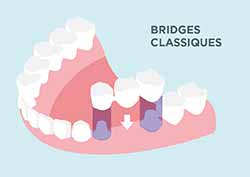 Bridge dentaire collé : quel remboursement par l'Assurance maladie ?
