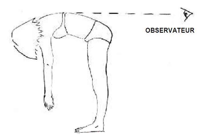 Figure I. Examen à la recherche d’une scoliose
