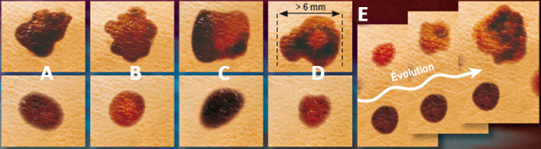 Haute Autorité de Santé - Mélanome cutané : la détection précoce ...