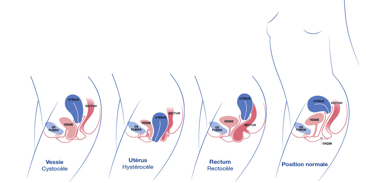 Haute Autorité de Santé Prolapsus génital de la femme Des solutions pour le traiter