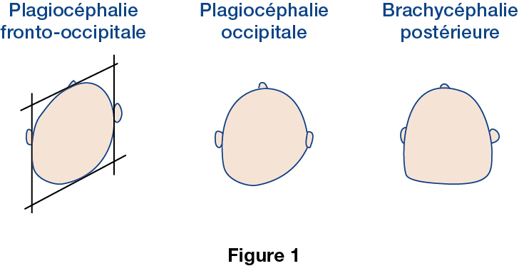 Figure 1 plagiocephalie