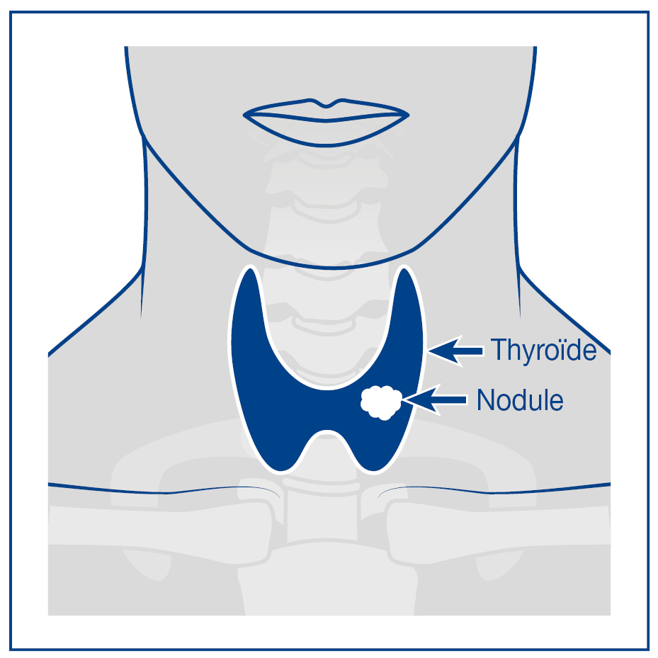 Haute Autorité de Santé - Nodule de la thyroïde - Comment l'explorer ?