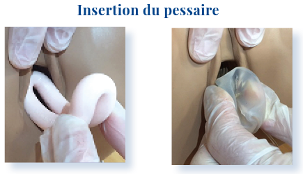 Pessaire anneau avec bouton en silicone ou pessaire anneau urétral